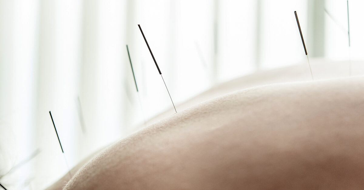 Hamilelik sırasında akupunktur sırt ve pelvik ağrıyı hafifletmeye yardımcı olabilir