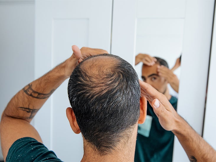 Saç dökülmesi için topikal finasterid: ne kadar işe yarıyor?